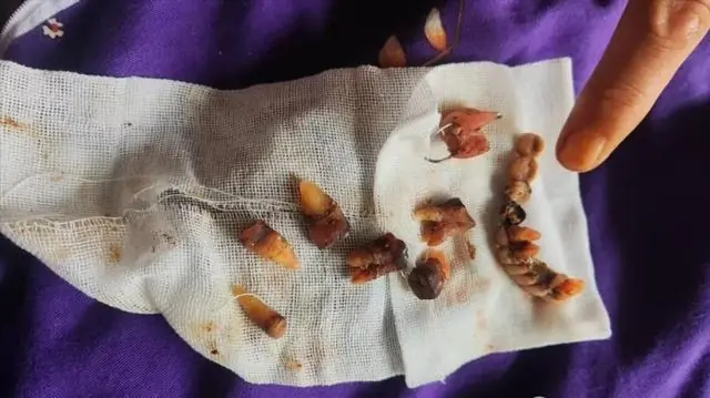 大风追踪|给心梗老人一次拔12颗牙种10颗,宝鸡渭滨区卫健局市监局全面调查处置,将对大团圆口腔医院顶格行政处罚